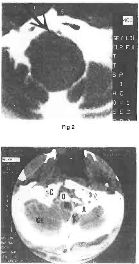 Figure 1 From The Localizing Value Of Downbeat Nystagmus Semantic