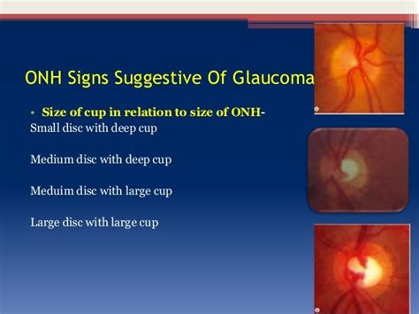 Optic Disc Changes In Glaucoma - Meduweb