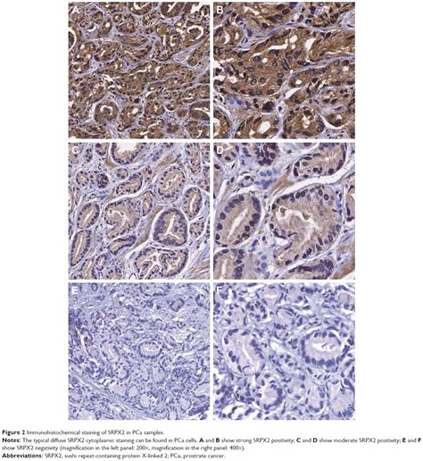 High Srpx2 Protein Expression Predicts Unfavorable Clinical Outcome In Ott