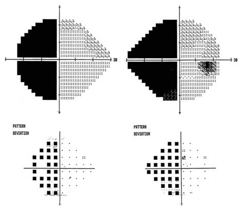 Approach To The Patient With Visual Loss Neupsy Key