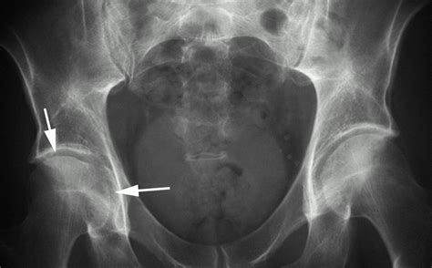 Evaluation Of The Marrow Space In The Adult Hip Radiographics