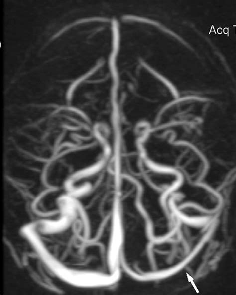 Transverse Venous Sinus Stenosis