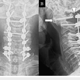 Case 2 (A) X-ray image after primary surgery (Oc-C7 fusion). (B) X-ray ...