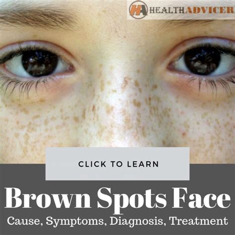 Brown Spots On Face: Causes, Picture, Symptoms And Treatment