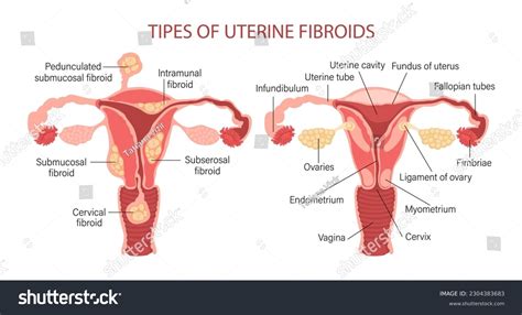 Types Uterine Fibroids Women Fibroids Diseases Stock Vector Royalty