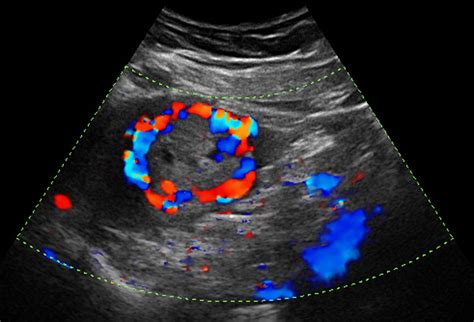 C Mo Afectan Los Quistes Ov Ricos A La Fertilidad Conceptum Fertilitat