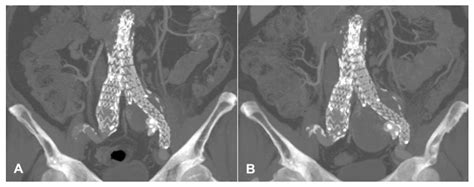 Jcm Free Full Text Percutaneous Retrograde Trans Gluteal