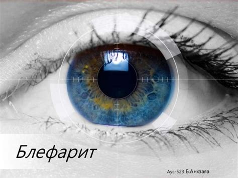 Блефарит