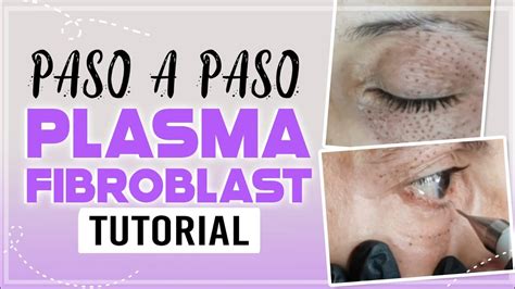 PLASMA PEN PÁRPADOS plasmapen plasma fibroblast YouTube