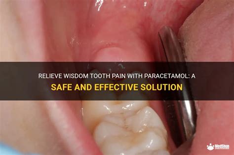 Relieve Wisdom Tooth Pain With Paracetamol A Safe And Effective