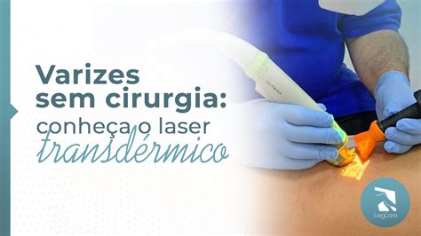 Varizes sem cirurgia conheça o laser transdérmico