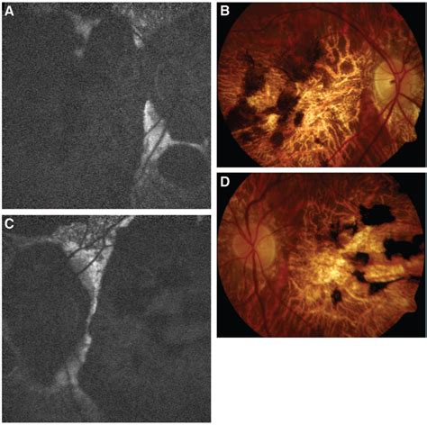 Case 1 Stgd With Peripapillary Atrophy And Mutations P1380l And Ivs40 Download Scientific