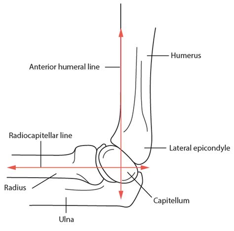 Radial Head Fractures Radial Head Fractures Msd Manual Professional Edition