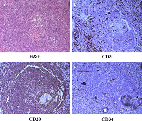 Histopathological Findings Of Hyaline Vascular Type Of Castlemans