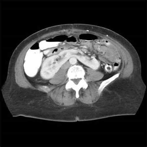 Horseshoe kidney | medicalrojak