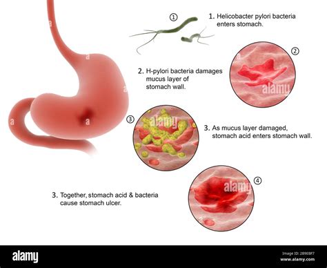 Diagrama Que Muestra El Proceso De Entrada De La Bacteria Helicobacter