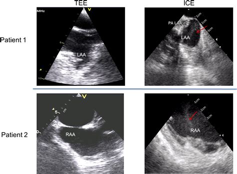 Comparison Of Intracardiac Echocardiography And Transesophageal