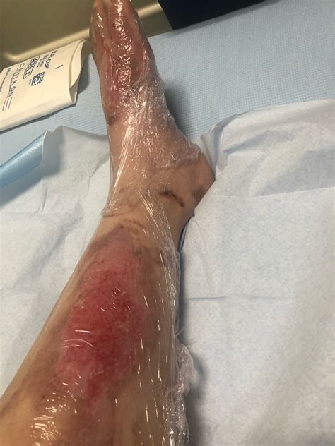 Student Suffers Second Degree Burns After Hot Water Bottle Explodes The Us Sun The Us Sun