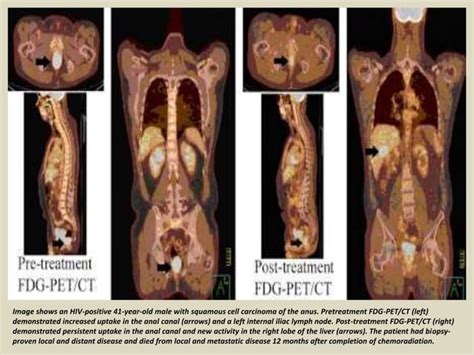 Presentation Radiological Imaging Of Anal Carcinoma PPTX