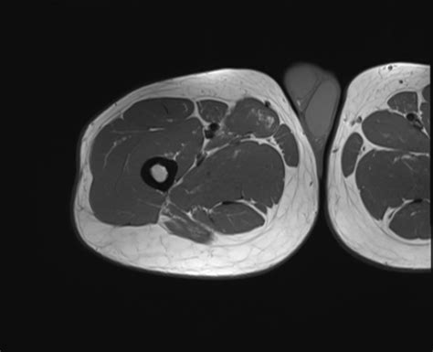 Muscles Of Thigh Mri