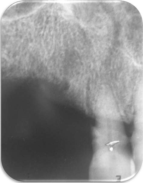 Intraoral Periapical Radiograph Of Maxillary Right Anterior Region