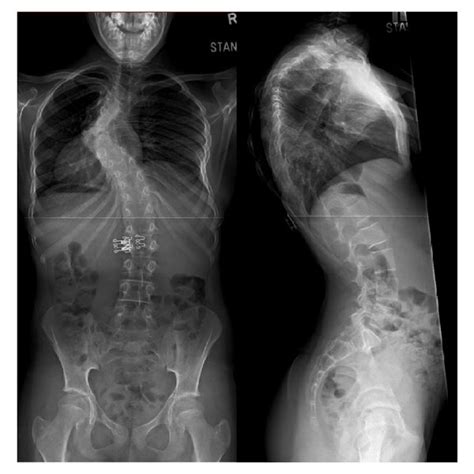 Preoperative Whole Spine Ap And Lateral X Ray A Preoperative Ct B Download Scientific