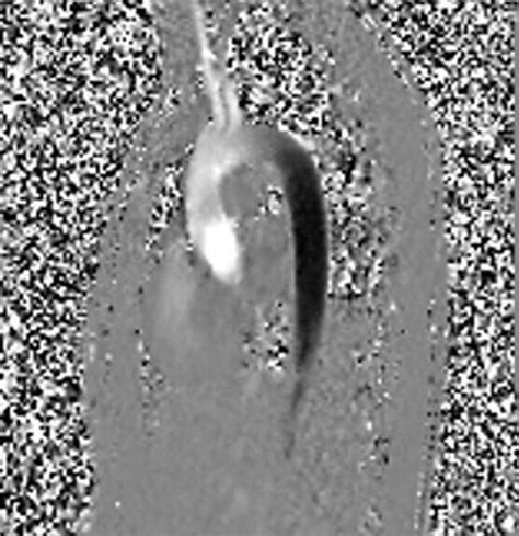 Phase contrast fow MRI | Phase contrast CSF and blood MRI physics and ...