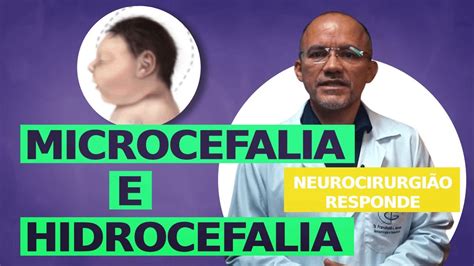 Quais As Diferen As Entre Microcefalia E Hidrocefalia Neurocirurgi O