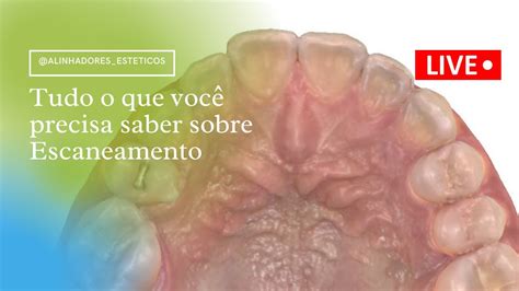 ESCANEAMENTO INTRAORAL TUDO O QUE VOCÊ PRECISA SABER YouTube