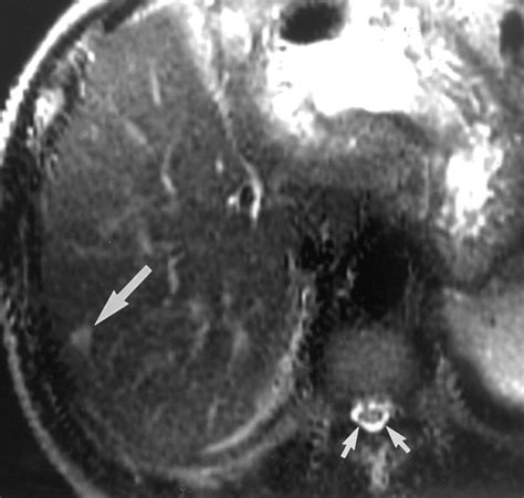 Hepatic Hemangioma Atypical Appearances On Ct Mr Imaging And Sonography Ajr