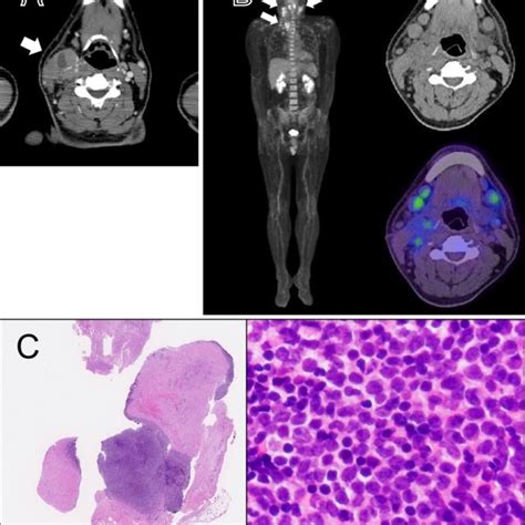 Figure1.A: A CT scan showed a supraclavicular mass with a low-density ...