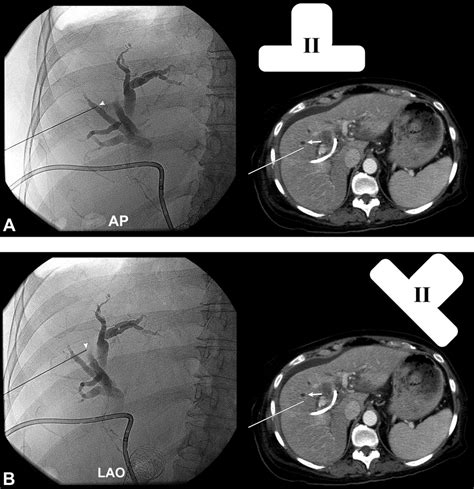 Transhepatic Techniques For Accessing The Biliary Tract Techniques In