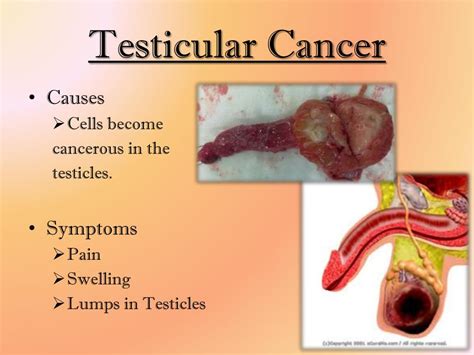 Epididymitis Lump