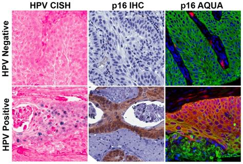 HPV 16 negative (top panels) and an HPV 16 positive (bottom panels ...