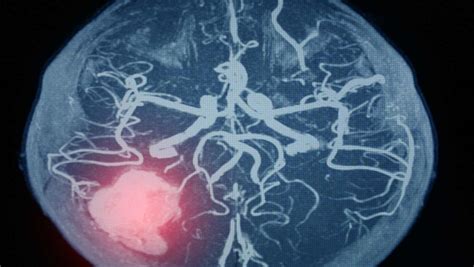 Different Ways Of Endovascular Aneurysm Repair Coiling VS Clipping