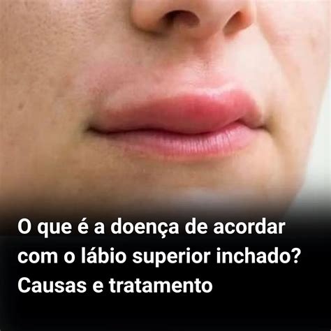 Lábio Inchado O Que Pode Ser - O que é a doença de acordar com o lábio superior inchado? Causas e ...