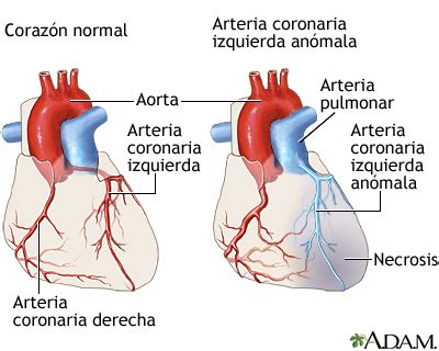 Arteria coronaria izquierda anómala MedlinePlus enciclopedia médica