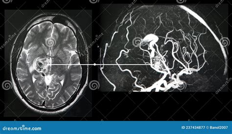 Brain Angiography CT Scan Reconstruction Malformation Stock Image