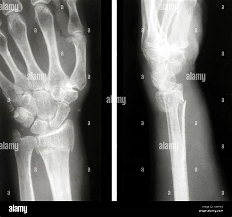 X Ray Colles Fracture Stock Photo 4054912 Alamy