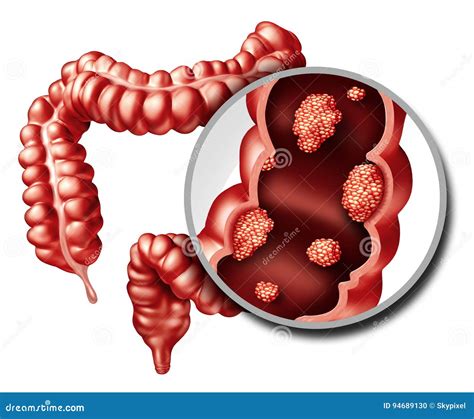 Concetto Del Tumore Del Colon Illustrazione Di Stock Illustrazione Di