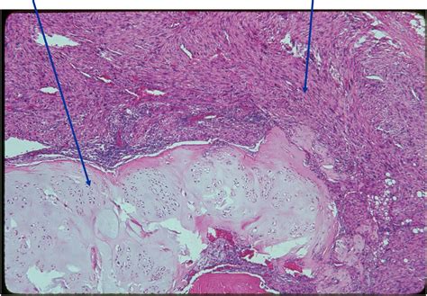 Dedifferentiated Chondrosarcoma Bone Tumor Cancer Tumors Of The Bone