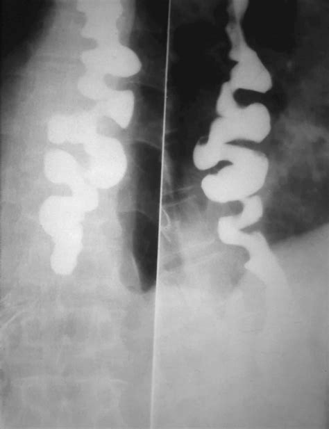 Corkscrew Appearance Of Esophagus New