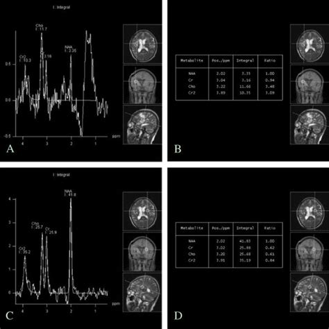 Magnetic Resonance Spectroscopy Mrs Analysis A Mrs Showed A