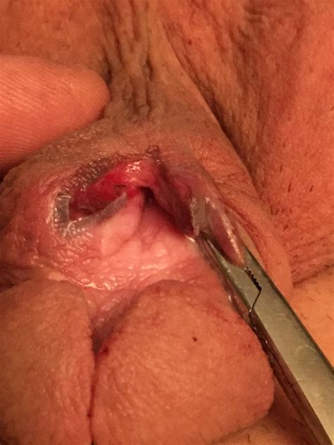 Subincision Photo Album By Cablecanyon XVIDEOS