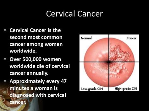 Cervical Cancer The Importance Of Cervical Screening And Vaccination…