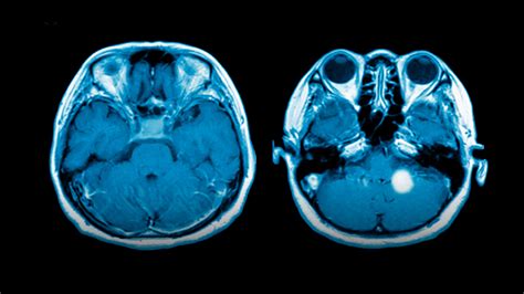 El gadolinio clave para detectar tumores cerebrales podría ser tóxico