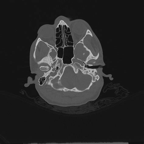 Dehiscent Jugular Bulb Image