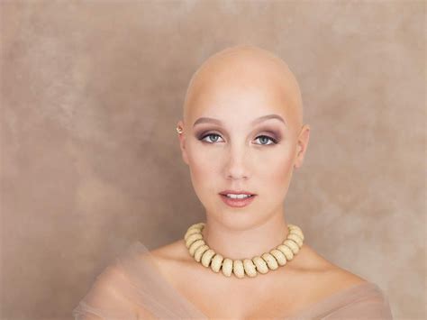 Meet The Inspiring Woman Embracing Her Alopecia Even On Her