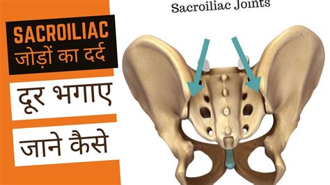 Sacroiliitis | Symptoms | Homeopathy Medicine & Treatment | Sacroiliac ...