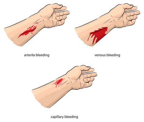 Bleeding Hands Images - Search Images on Everypixel